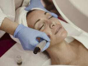 i vantaggi del microneedling 2
